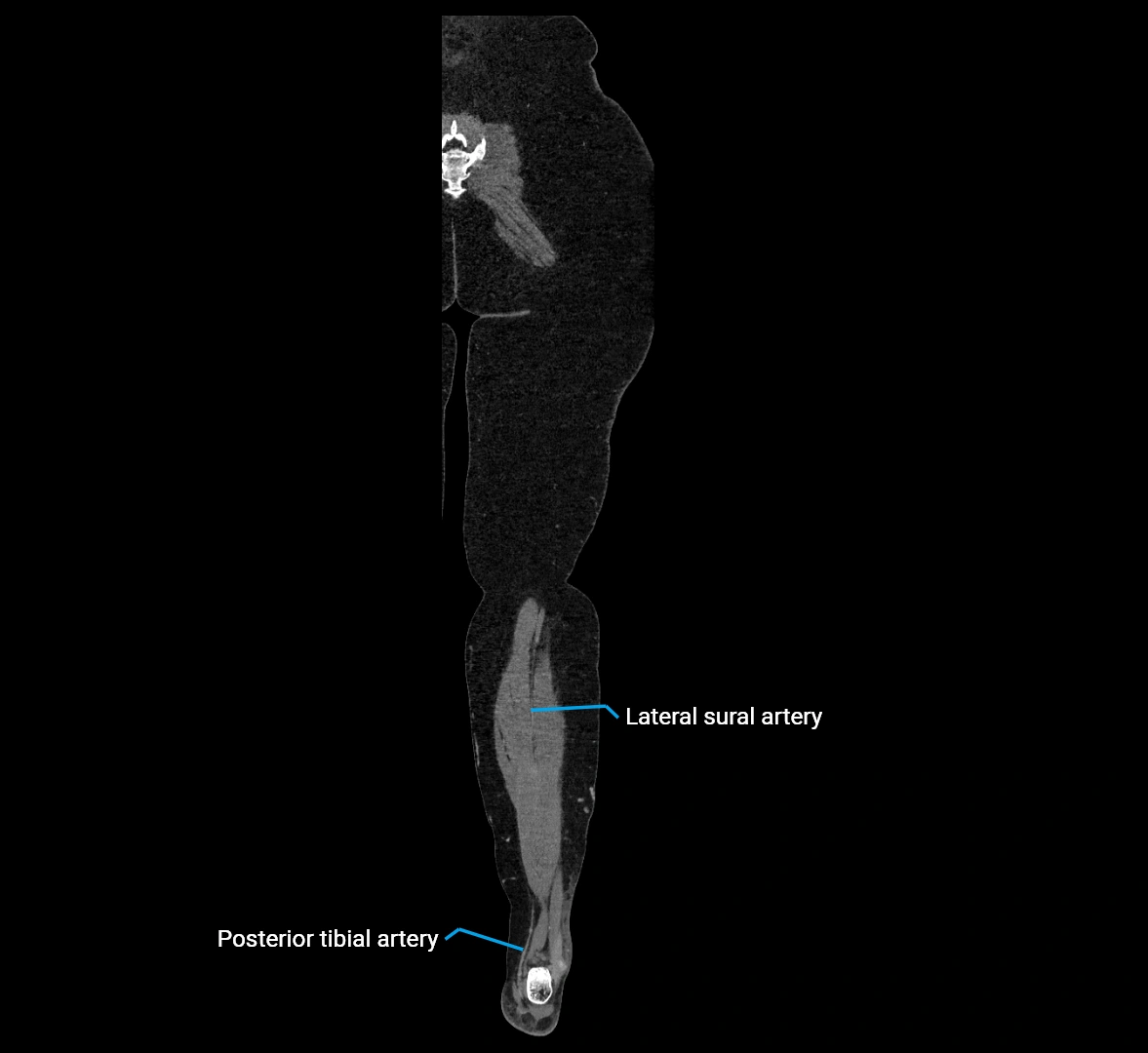 CTA lower limb coronal cross sectional anatomy labelled image _80 (2).webp